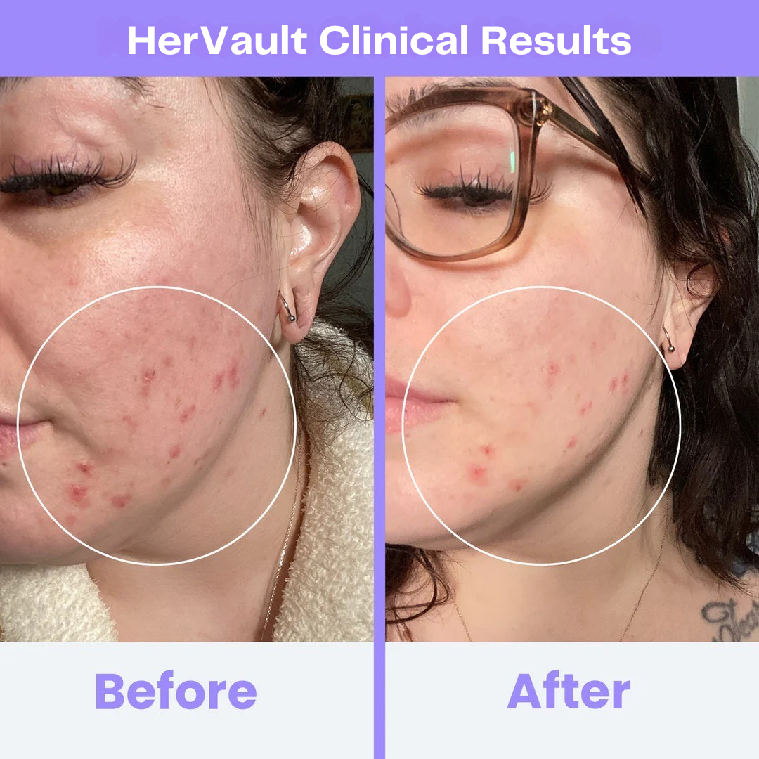 HerVault CLINICAL HIGH FREQUENCY WAND