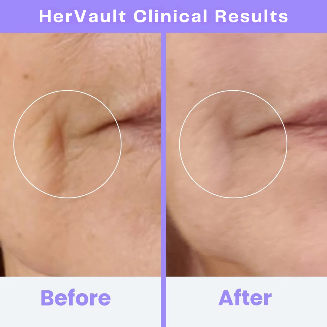 HerVault CLINICAL HIGH FREQUENCY WAND