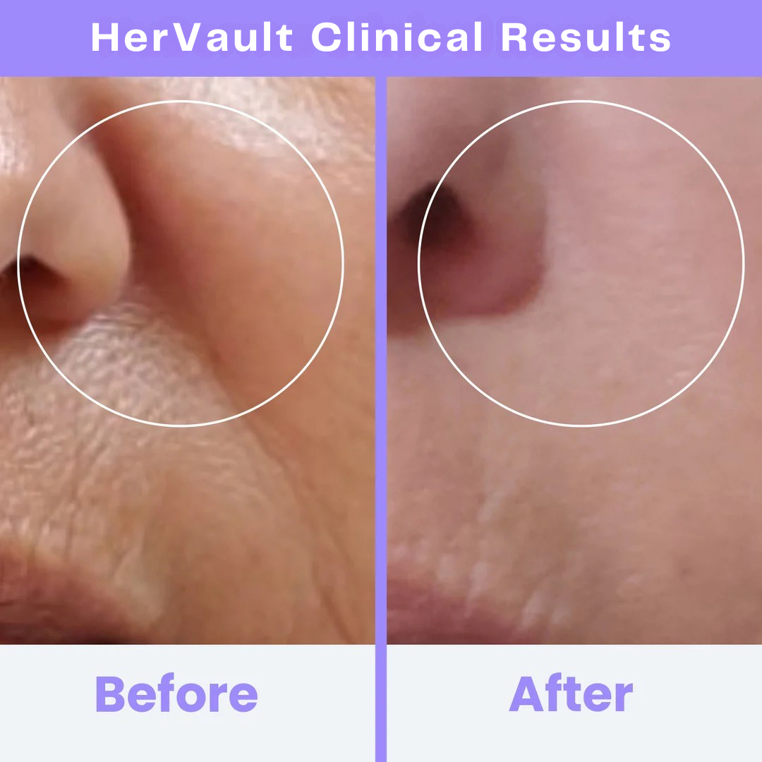 HerVault CLINICAL HIGH FREQUENCY WAND